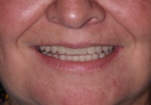Implant Retained Denture After Shot